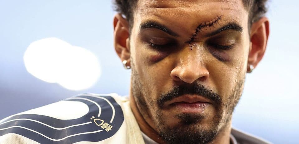 Player with facial injury and stitches during warm-up