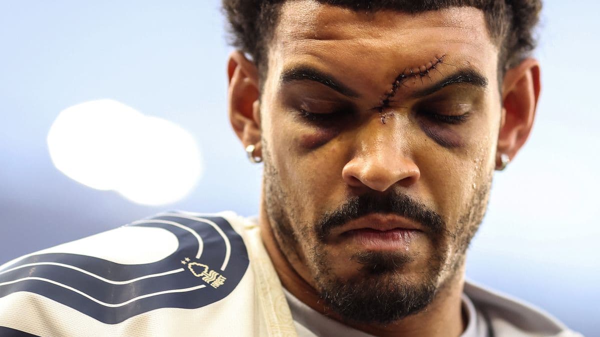 Player with facial injury and stitches during warm-up Player with facial injury and stitches during warm-up